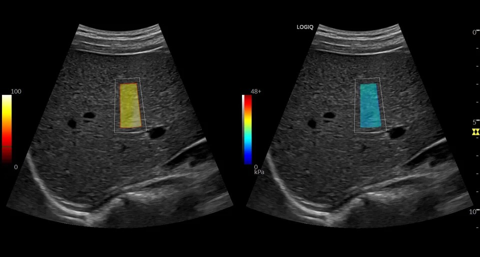 2D Shear Wave Elastography