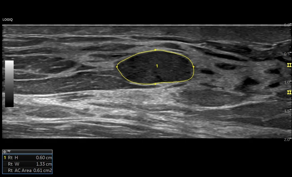 Auto Lesion Segmentation Breast, ML6-15-D
