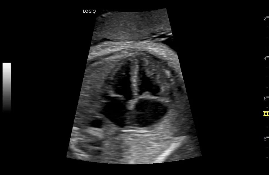 Obstetric 4CH B-Mode, C1-6-D
