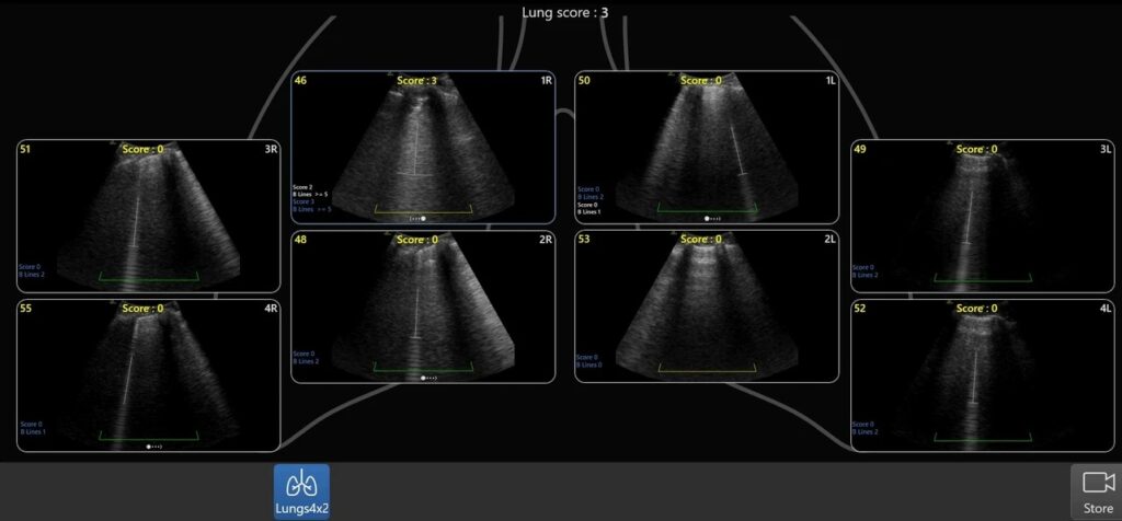 Lung Diagram Review, single view of anatomical lung segments