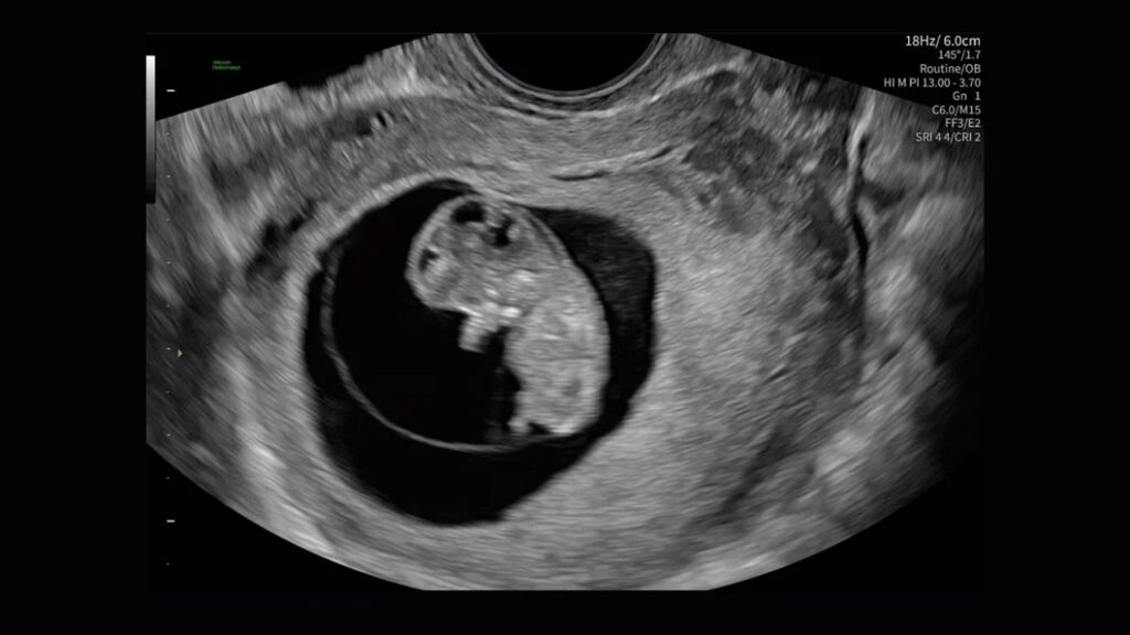 10 Week Fetus
