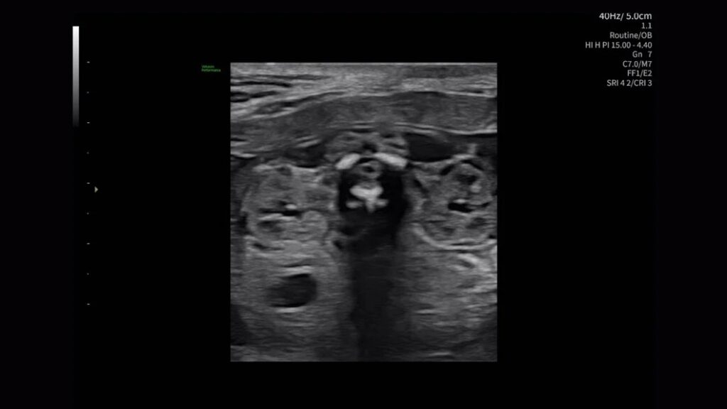 22 Week Fetal Kidneys
