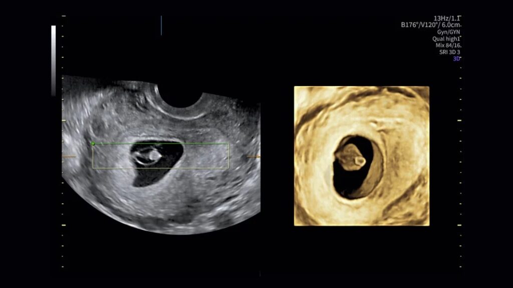 7 Week Fetus