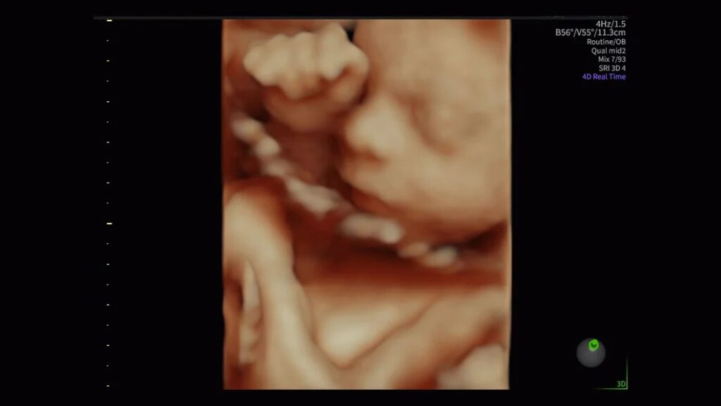 HDLive 26 Week Fetal Face