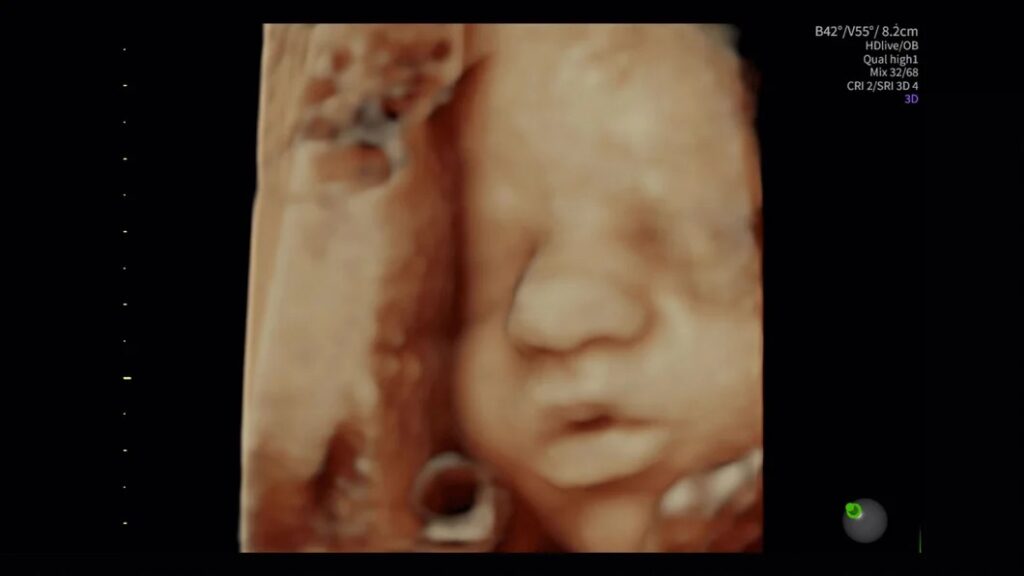 HDLive 30 Week Fetus