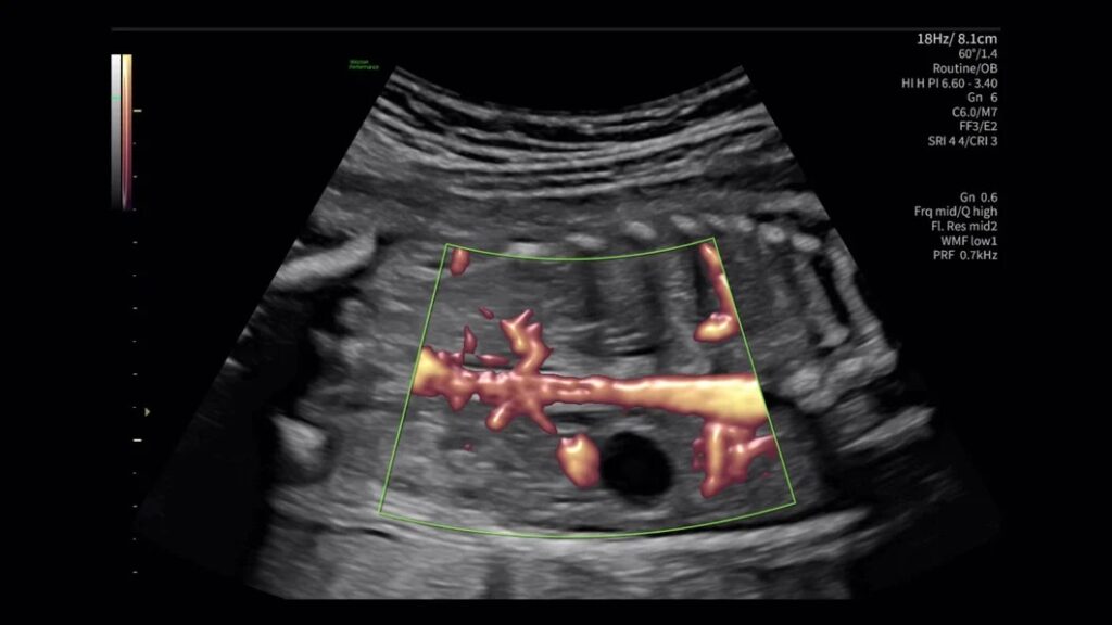 RadiantFlow 24 Week Renal Arteries