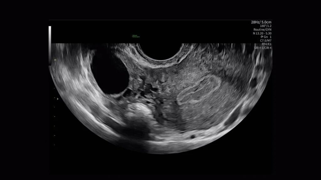 Pelvic Health BetaView of Ovaries and Uterus