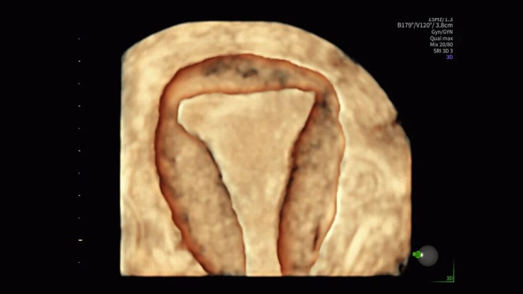 Pelvic Health HDLive Uterus