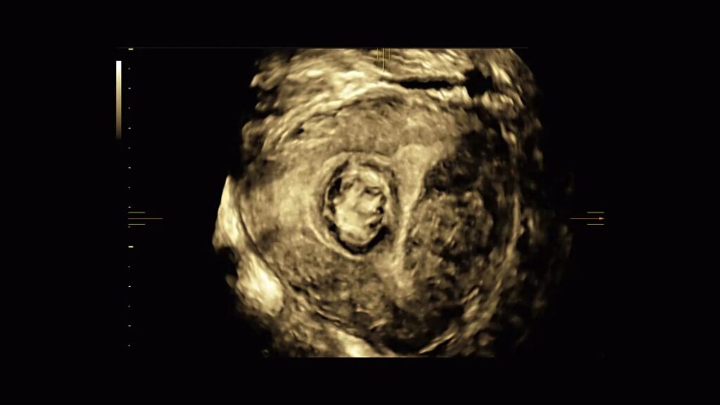 Pelvic Health Volume Contrast Imaging Fibroid