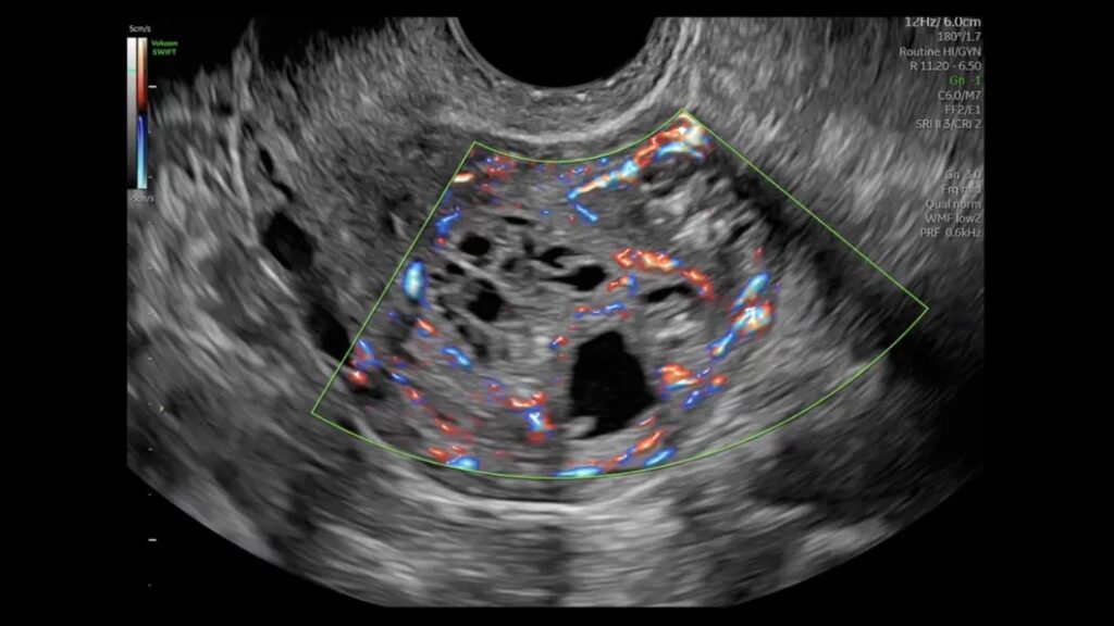 RF Uterus