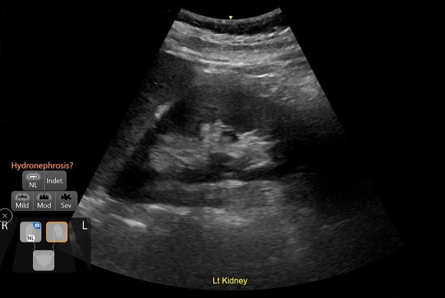 Renal Diagram, Vscan Air CL - Curved