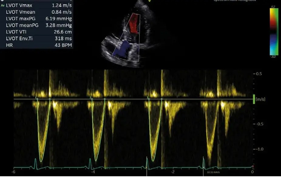Cardiac Auto Doppler