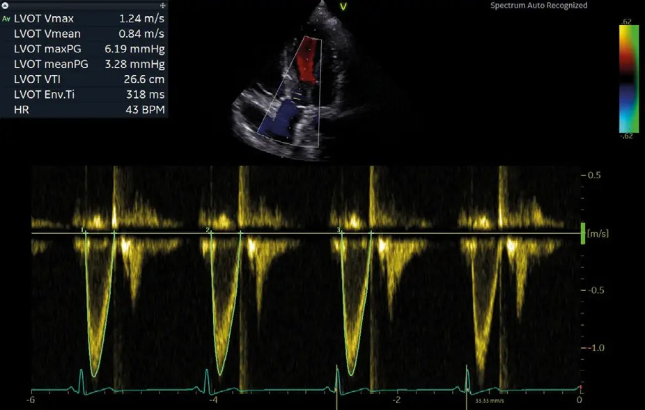 Cardiac Auto Doppler