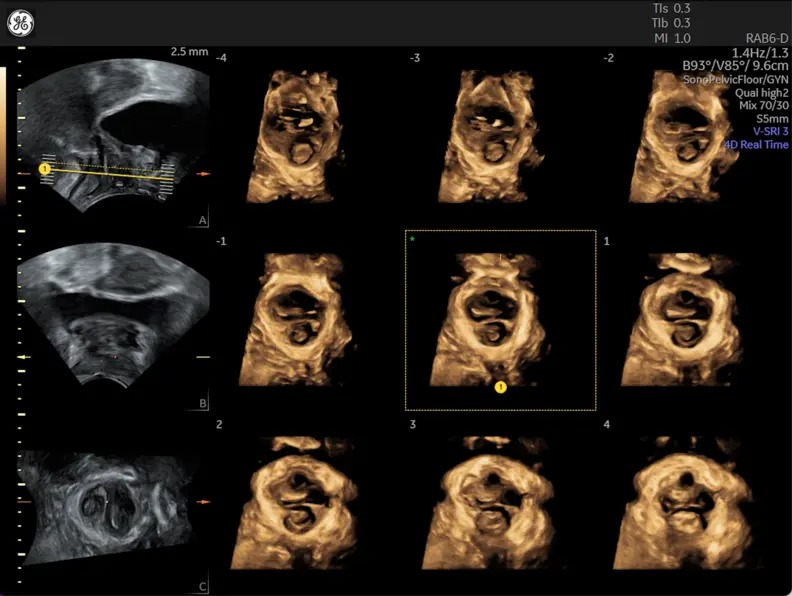 Serial Planes of the pelvic floor anatomy