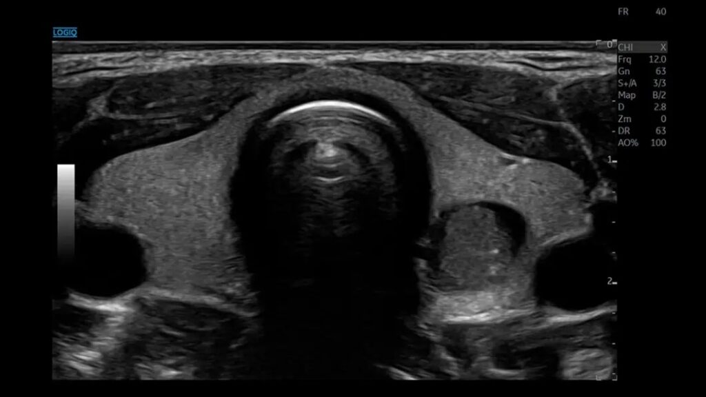 Thyroid, Advanced SRI, ML6-15