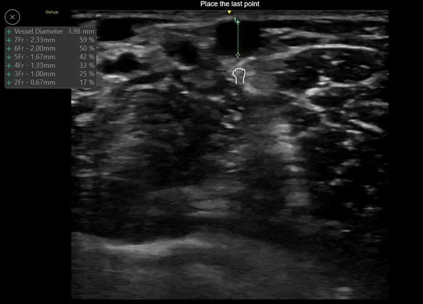 Catheter to Vessel Ratio, VScan Air CL - Linear
