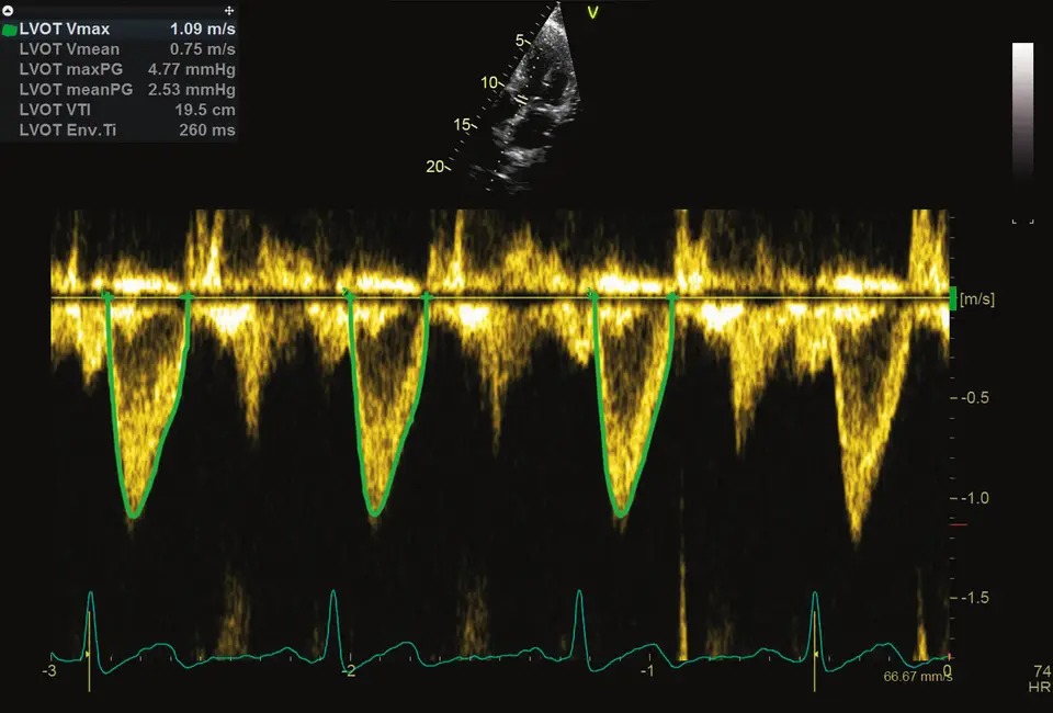 AI Cardiac Auto Doppler