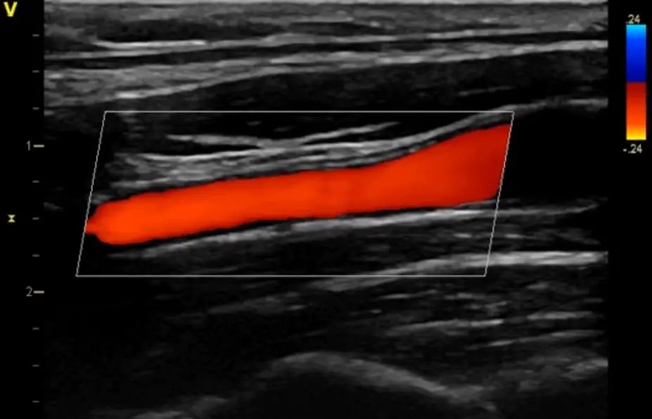 Blood Flow Imaging