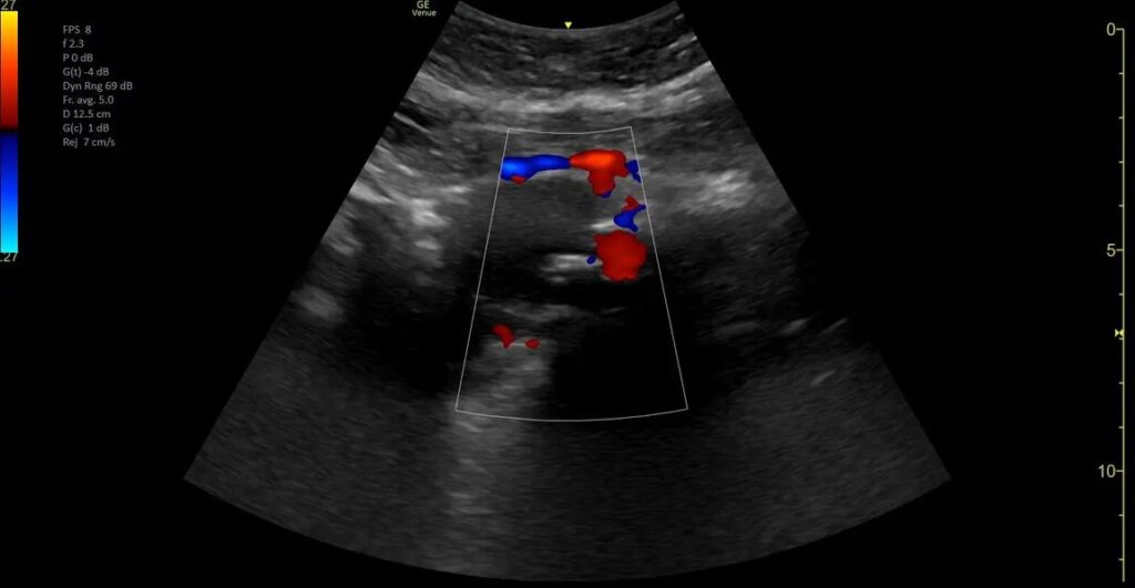 Abdominal Aortic Anuresym with Color Flow VScan Air CL - Curved