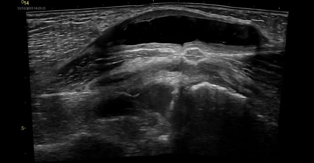 Baker's Cyst, Venue View, VScan Air CL - Linear