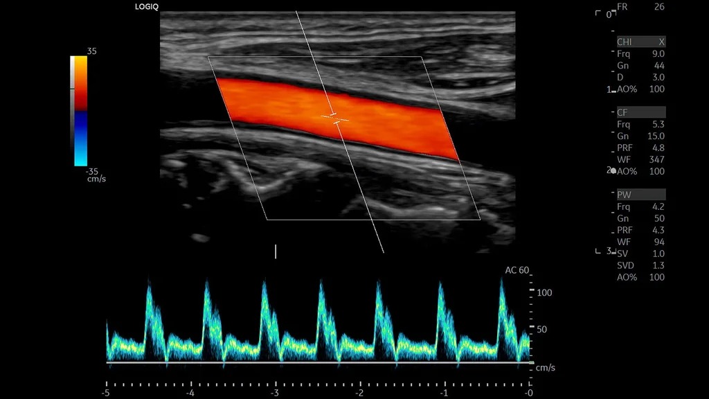 Carotid PW Waveform, L2-9-D