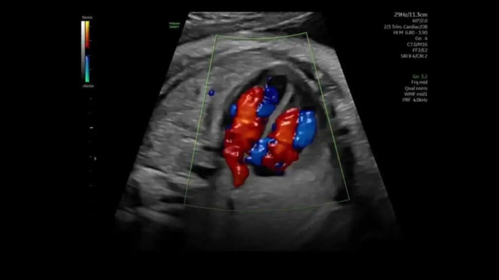 Color Doppler
