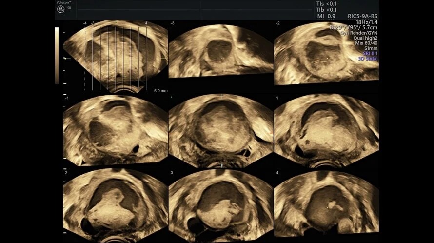 Complex Ovarian Mass