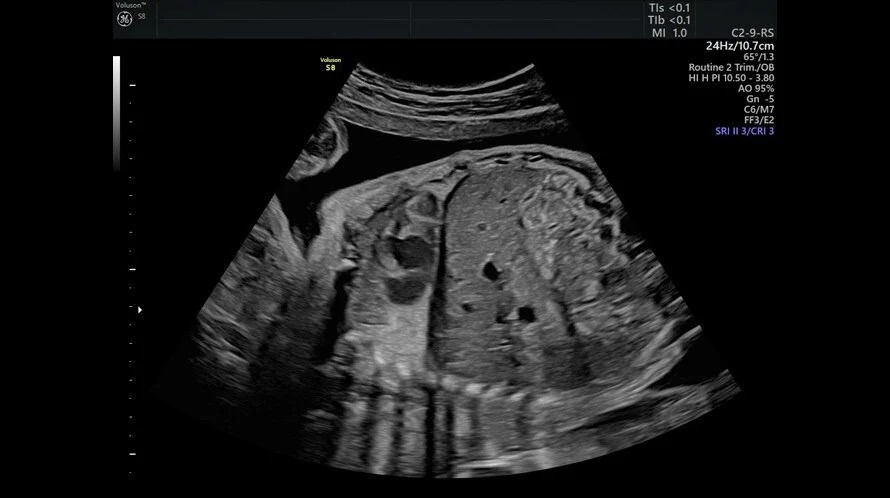 Fetal Diaphragm