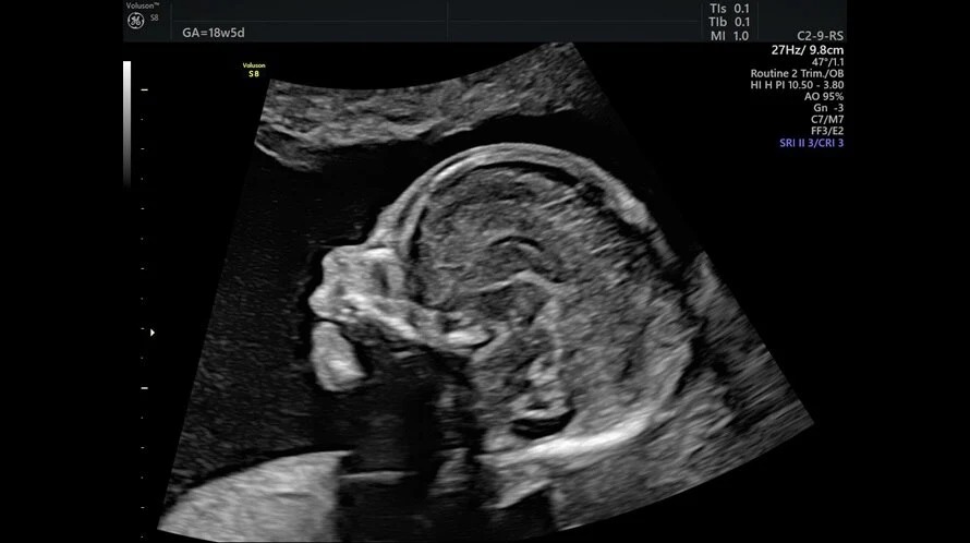Fetal Profile