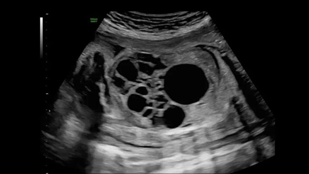 Fetal Kidney