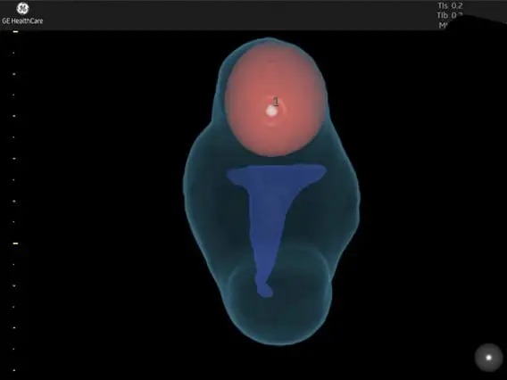 Fibroid mapping