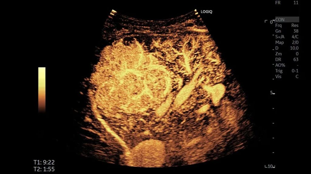 FNH with CEUS, C1-6-D