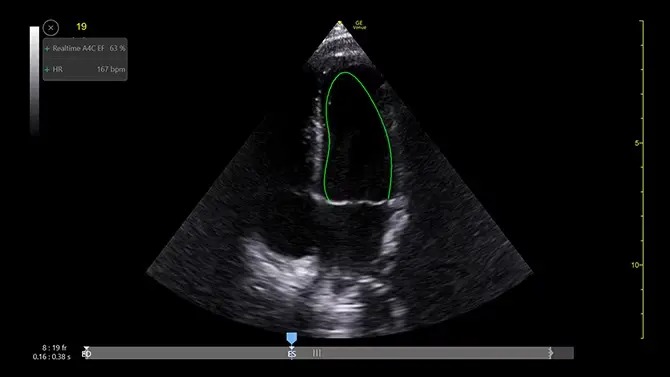 Real Time EF Pediatric, A4CH, 6S-RS