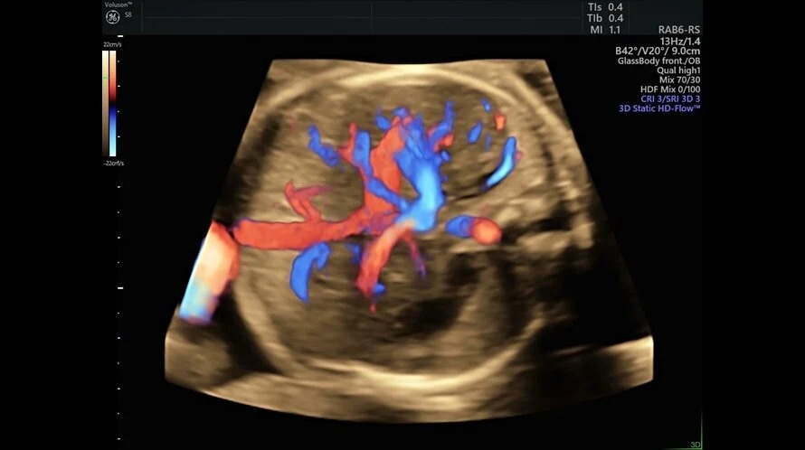 HD Flow Abdomen