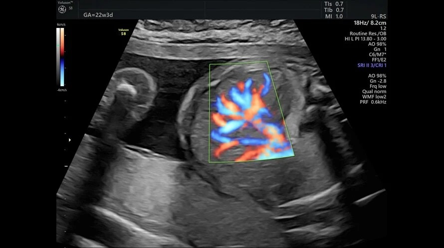 HD Flow Fetal Liver