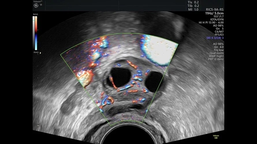 HD Flow Ovaries