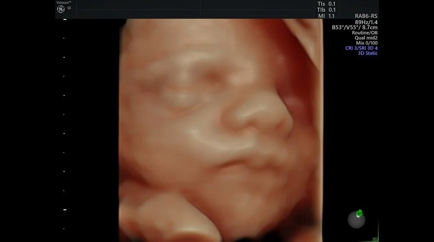 HD Live Fetal Face