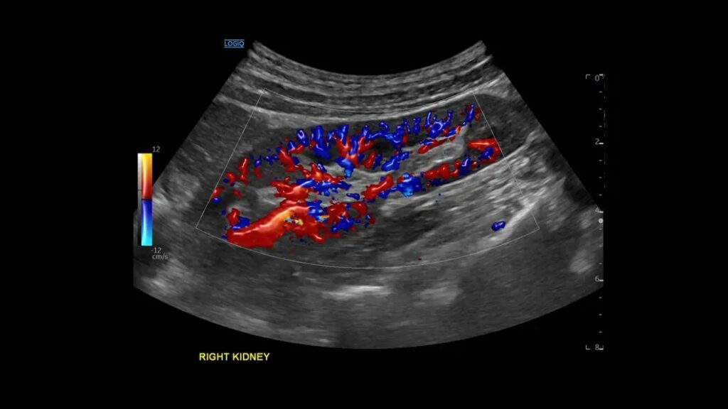 Renal using Color Flow & Radiant Flow