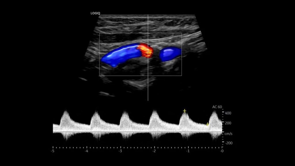 Carotid Artery using Color Flow & Radiant Flow & PW, 9L-D