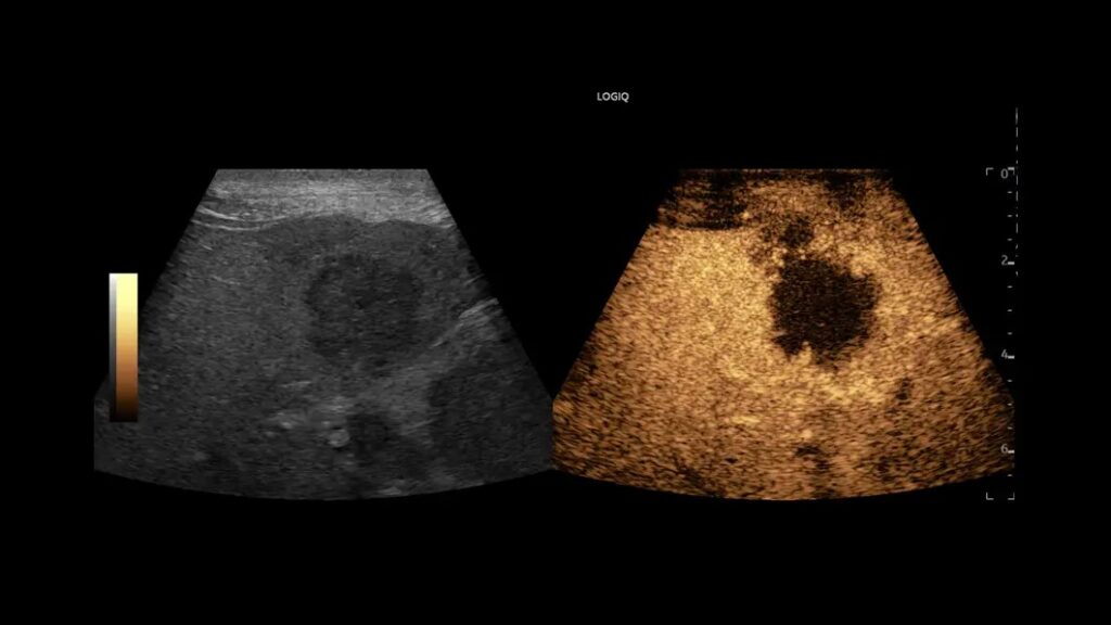 Liver Masses with CEUS 9L-D