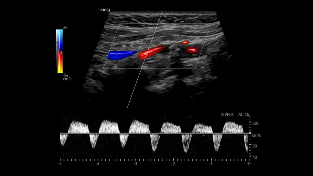 Vertebral artery bi-directional flow, Color Flow with Radiant Flow & PW, 9L-D