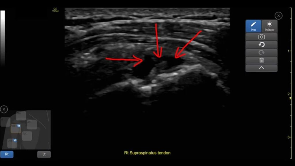 Scribble assistance, Right Supraspinatus Tendon Tear