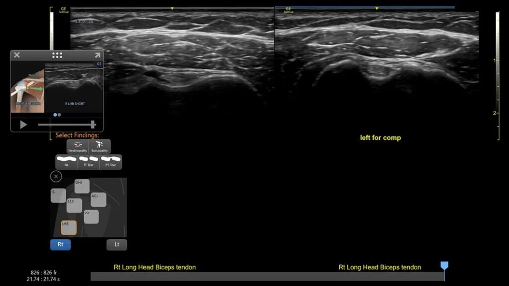 Shoulder Diagram, Long head biceps, Right & Left Comparison L4-20t-RS