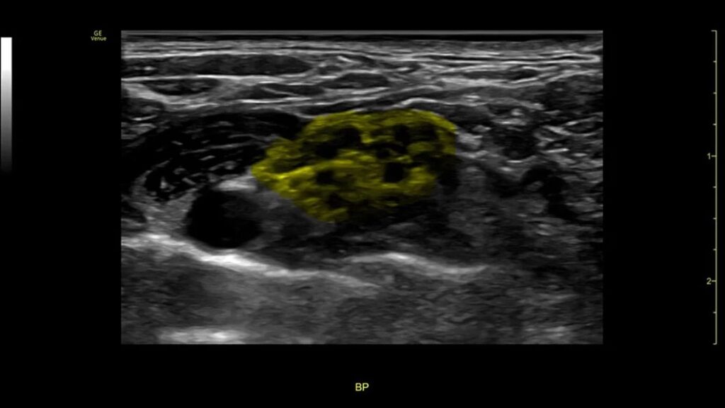 cNerve Brachial Plexus landmark HighlightedL4-20t-RS