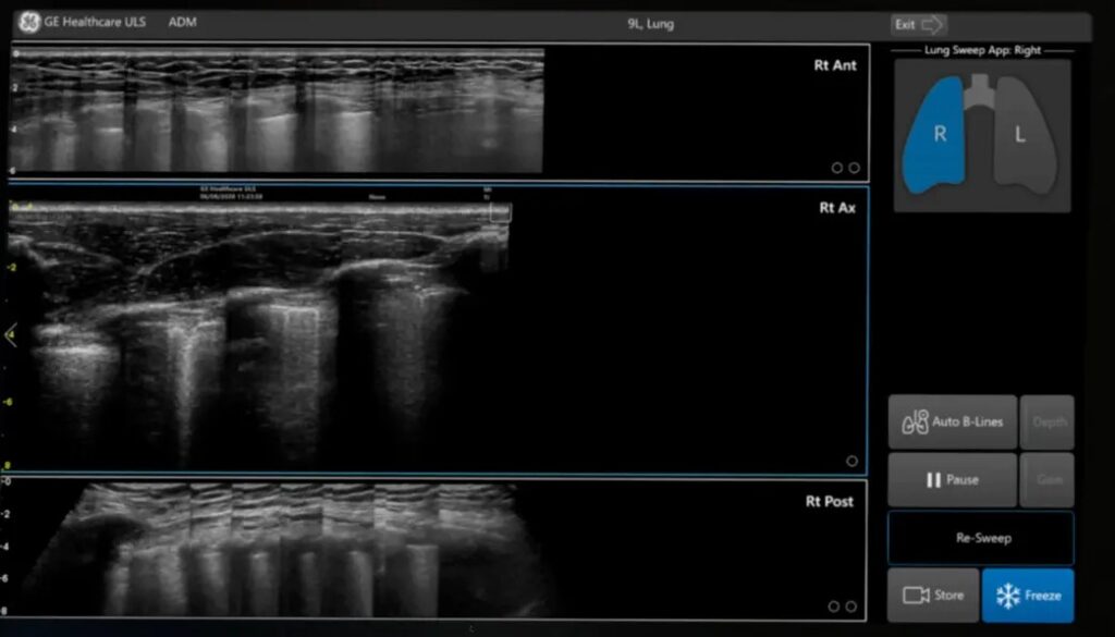 Lung Sweep, Panoramic View of the Entire Lung COVID