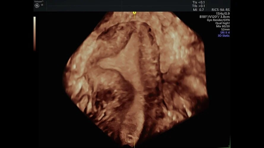 Omniview Uterus