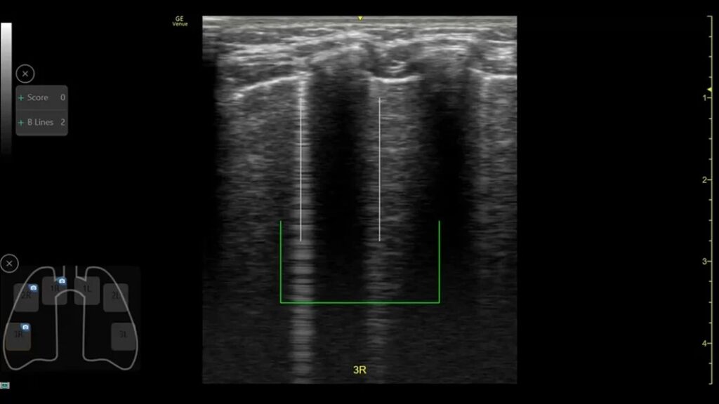Auto B-Lines tool, Calculate overall Lung Score