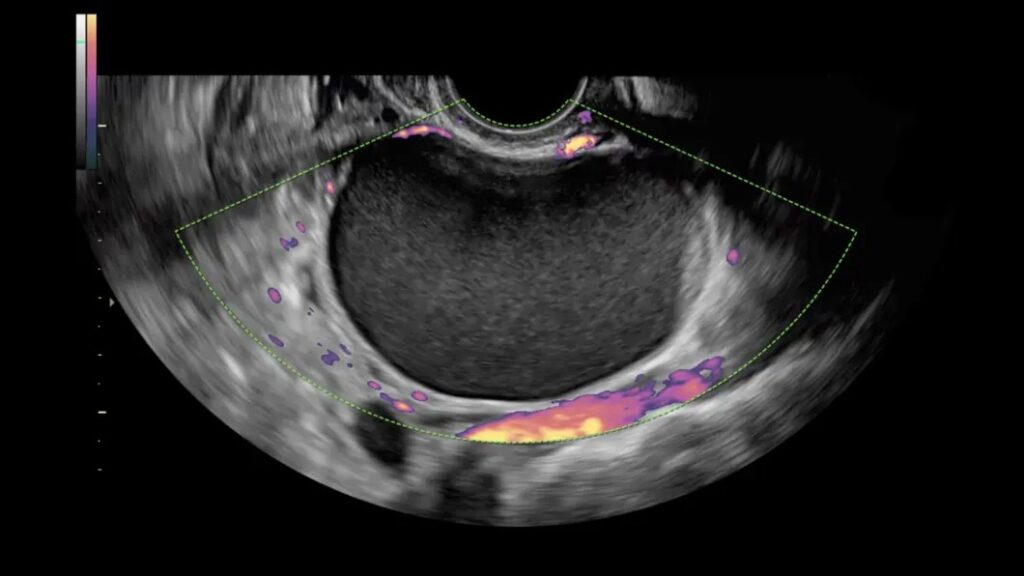 Power Doppler Endo