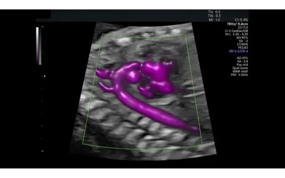 Radiant Flow Aortic Arch