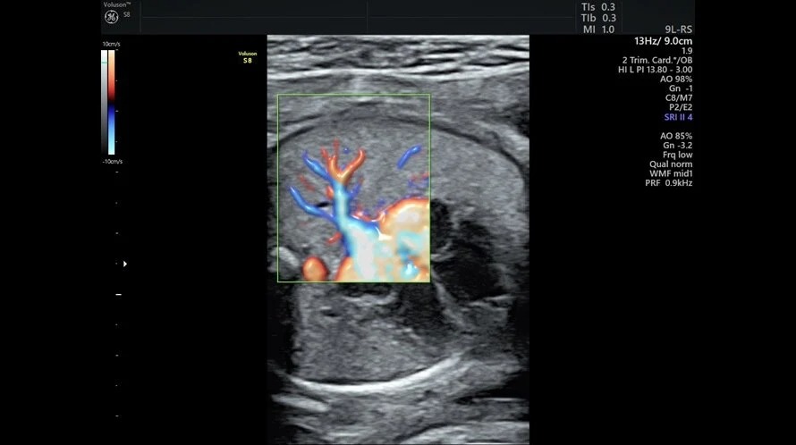 Radiant Flow Fetal Heart
